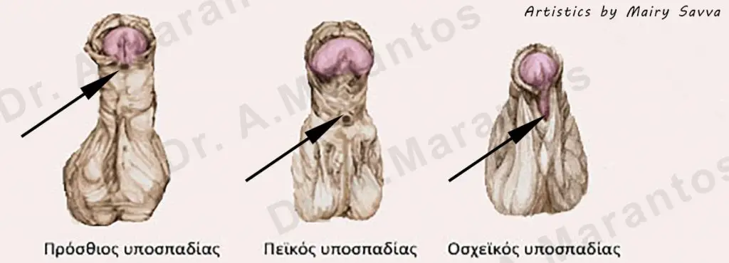 Τύποι υποσπαδία