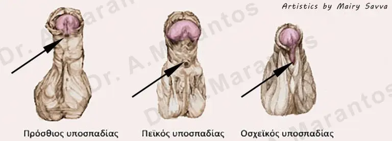Hypospadias-Types